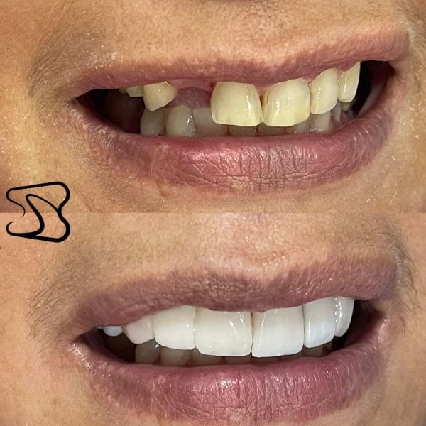 Oral rehabilitation