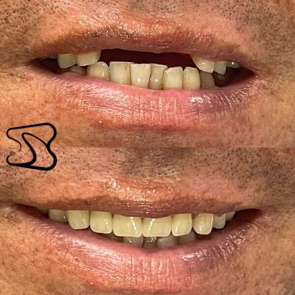 Dentures