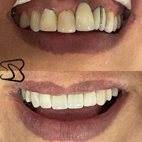 Veneers