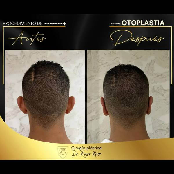 Otoplasty