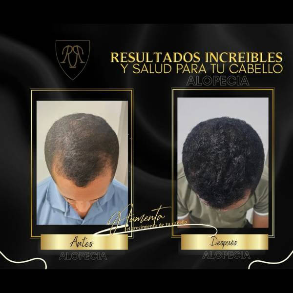 Alopecia