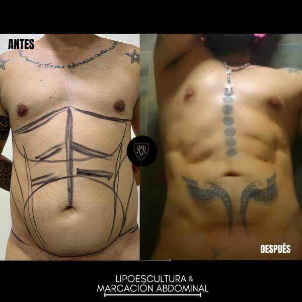 Men Abdominal Etching