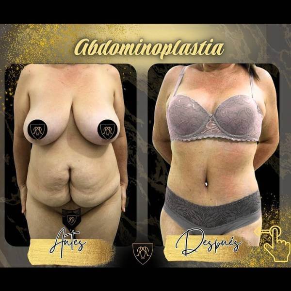 Tummy Tuck