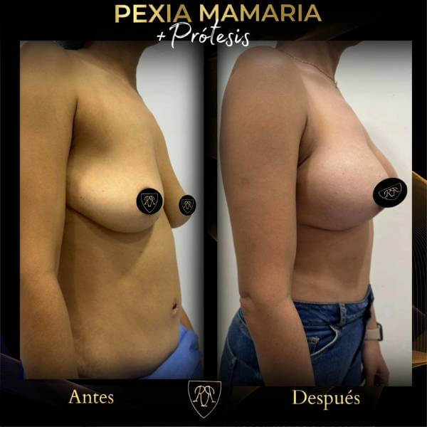Breast Lift