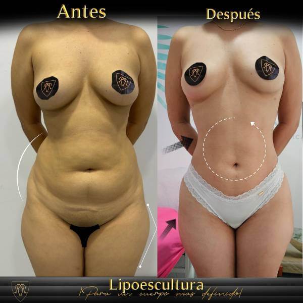 Liposculpture