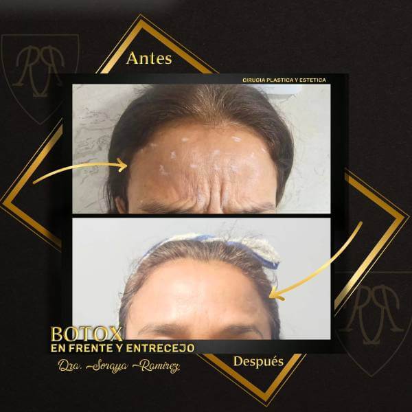 Botulinum toxin
