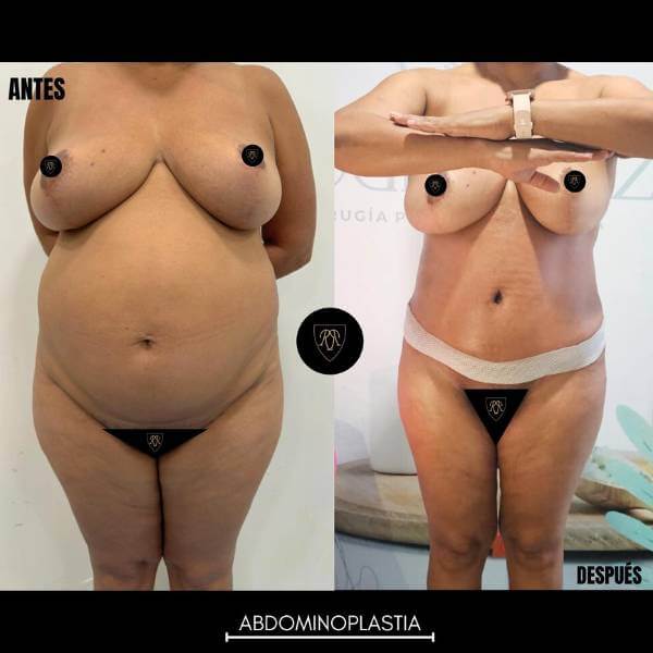 Tummy Tuck