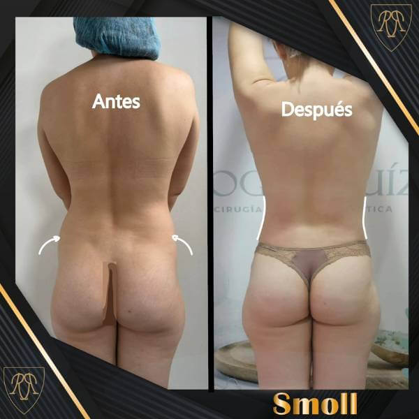 Body contouring treatment