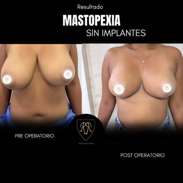 Breast Lift