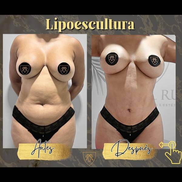 Liposculpture