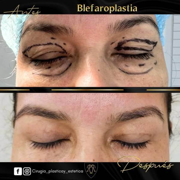 Eyelid Surgery