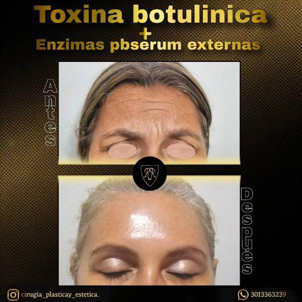 Botulinum toxin
