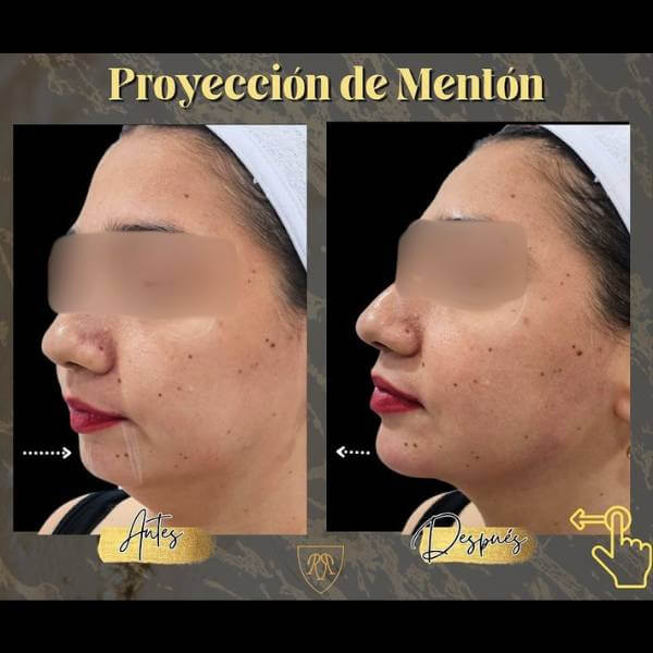 Non-Surgical chin correction