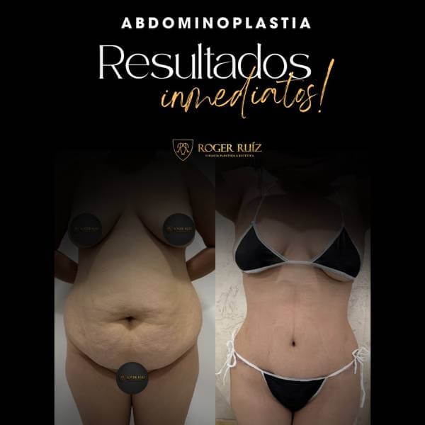 Tummy Tuck