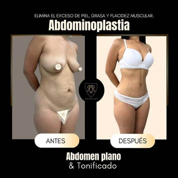 Tummy Tuck