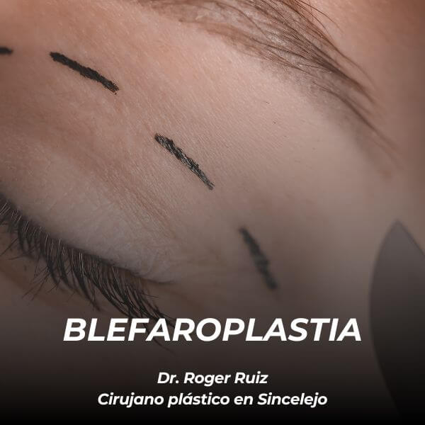 Blefaroplastia