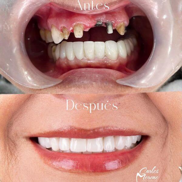 Oral rehabilitation
