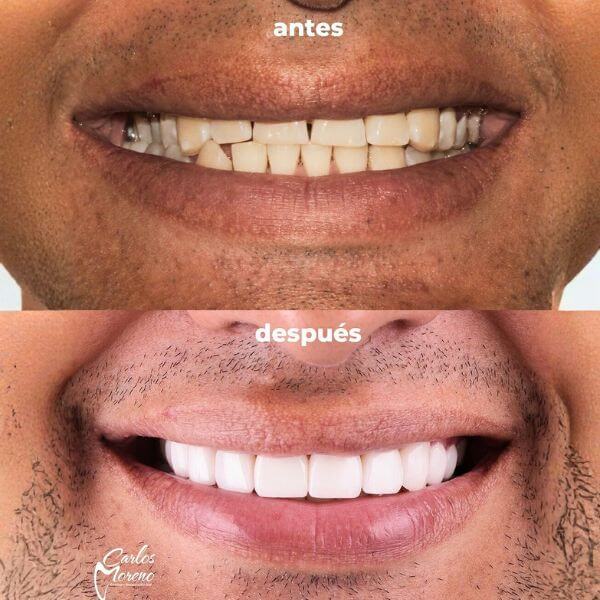 Smile design