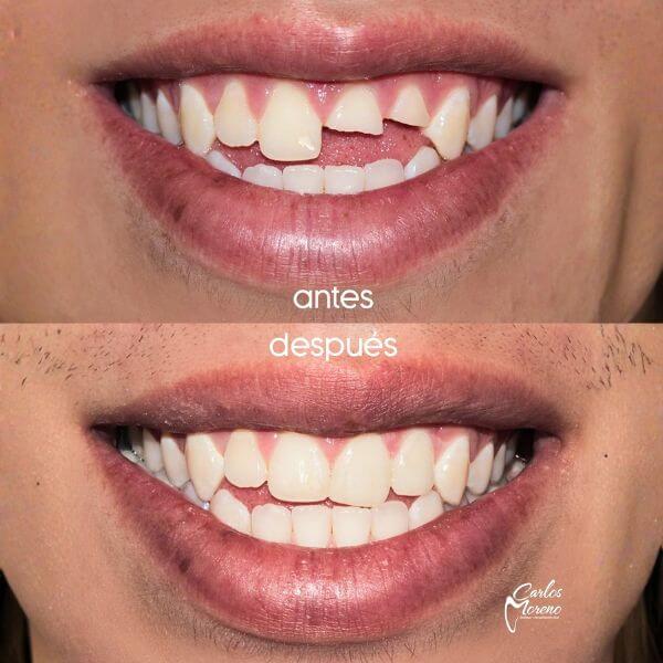 Tooth Fracture