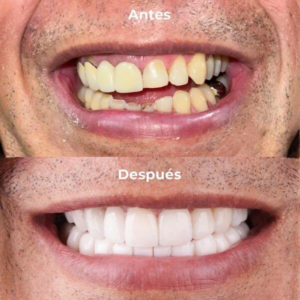 Smile design