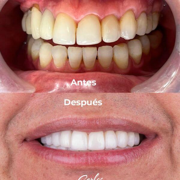 Oral rehabilitation