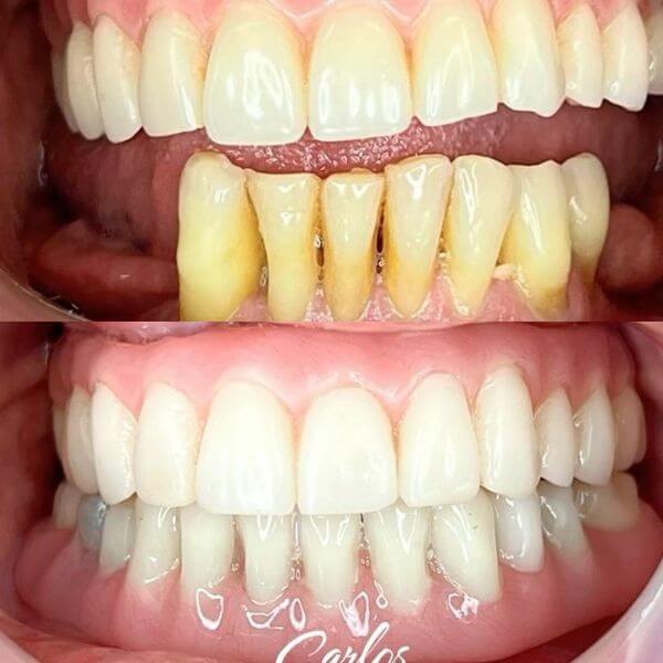 Oral rehabilitation