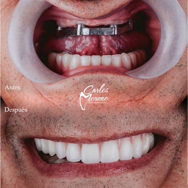 Dentures