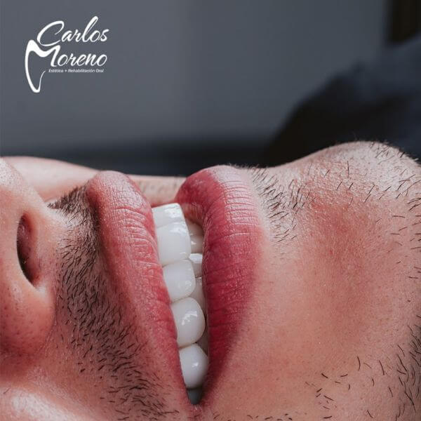 Smile design