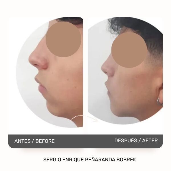 Chin Surgery