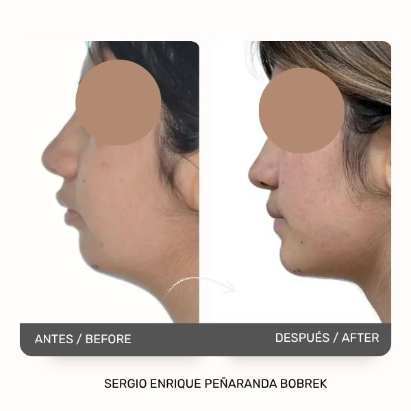 Chin Surgery