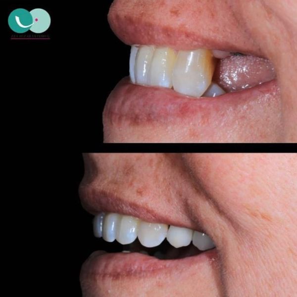 Dental implants