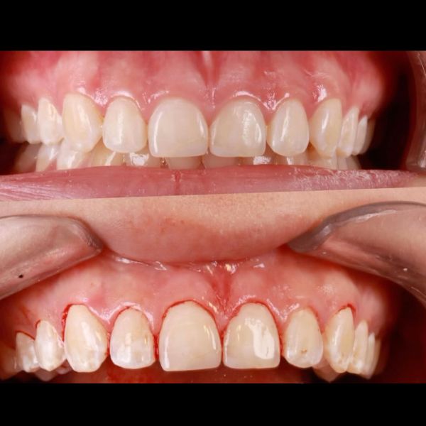 Gingivectomy