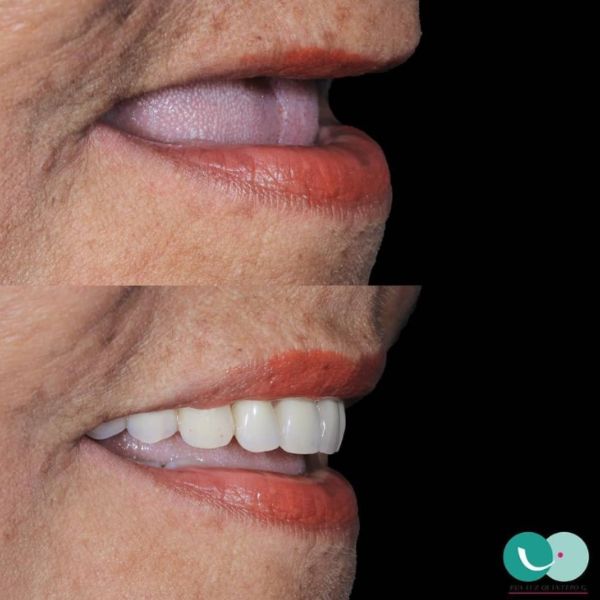 Dentures
