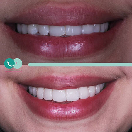 Smile design