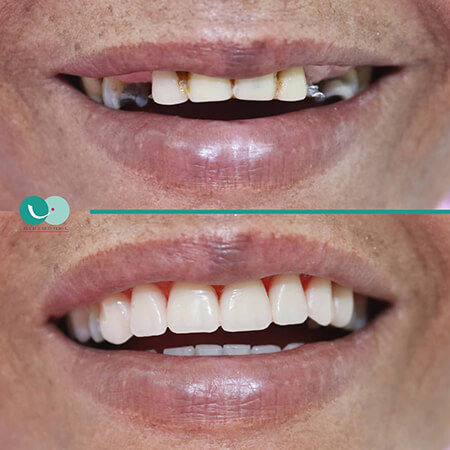 Dental implants
