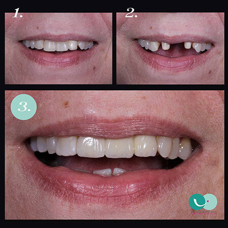 Dental implants