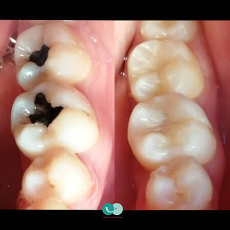 Silver filling replacement