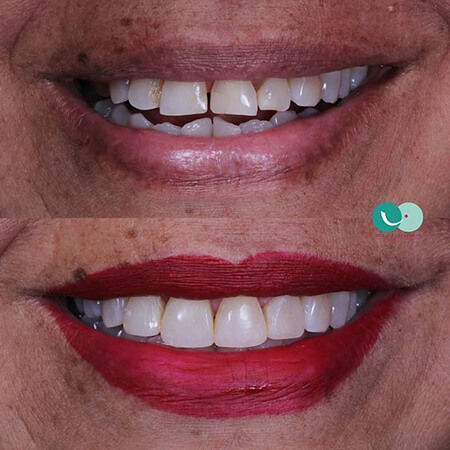 Smile design