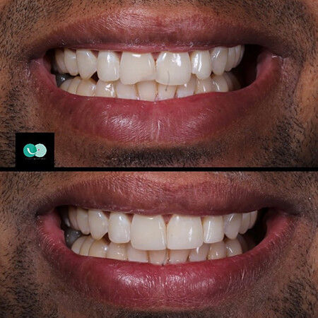 Smile design