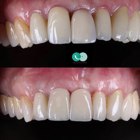 Dental crown