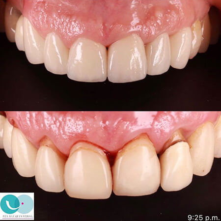 Gingivectomy