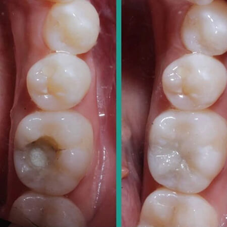 Silver filling replacement