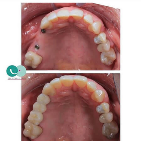 Dental implants