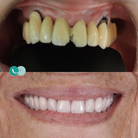 Oral rehabilitation