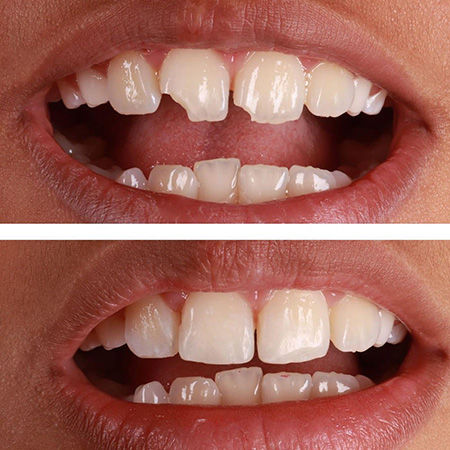 Tooth Fracture