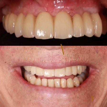 Dentures