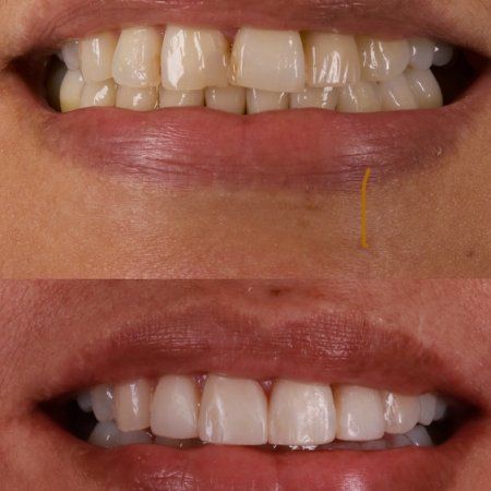 Smile design