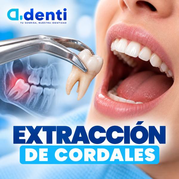 Extracción de cordales