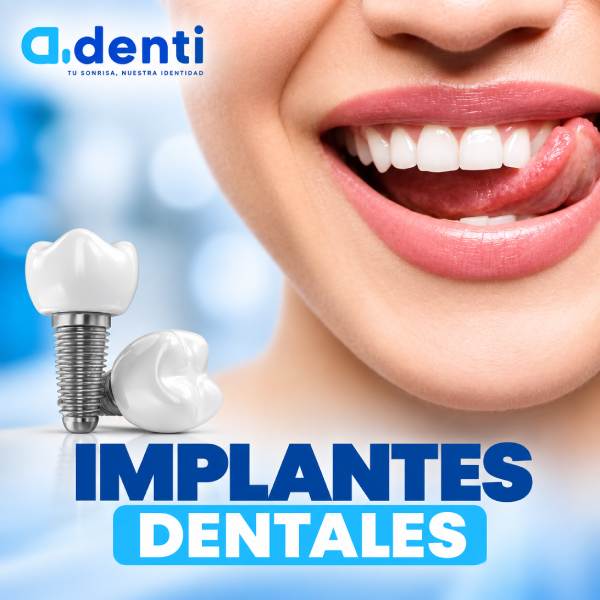 Implantes dentales