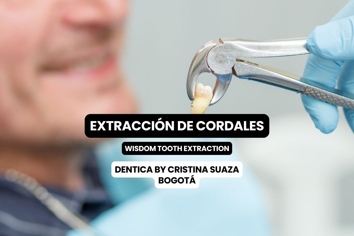 Extracción de Cordales en Bogotá: cirugía segura y especializada con Dentica by Cristina Suaza